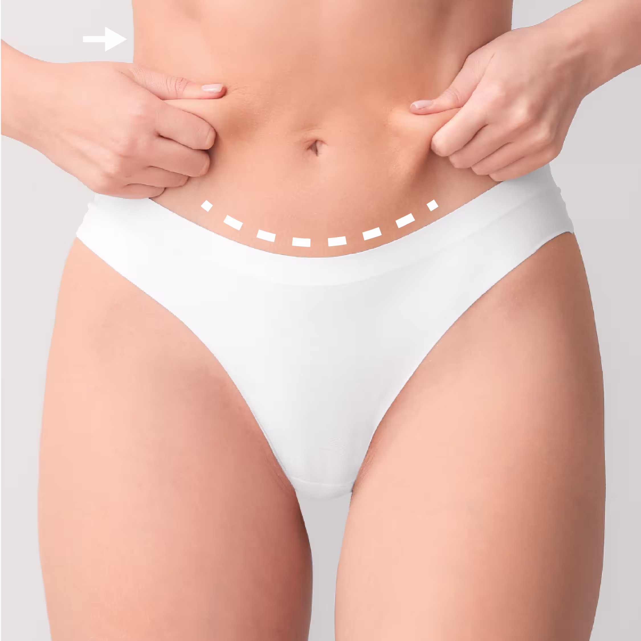 Abdominoplastia